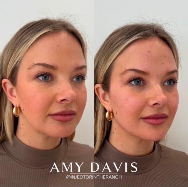 Full face filler rejuvenation results before and after