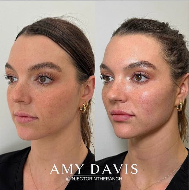 side profile jawline and chin filler before and after