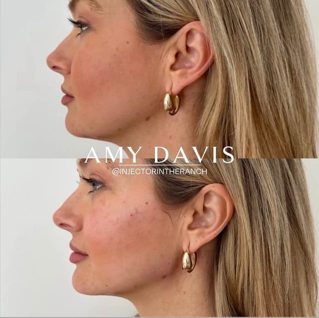 Jawline Filler before and after