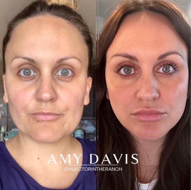 Midface Lift + Under-Eye Support