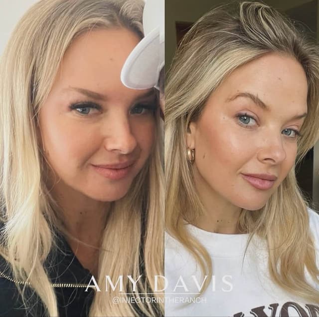 Full face filler rejuvenation results before and after