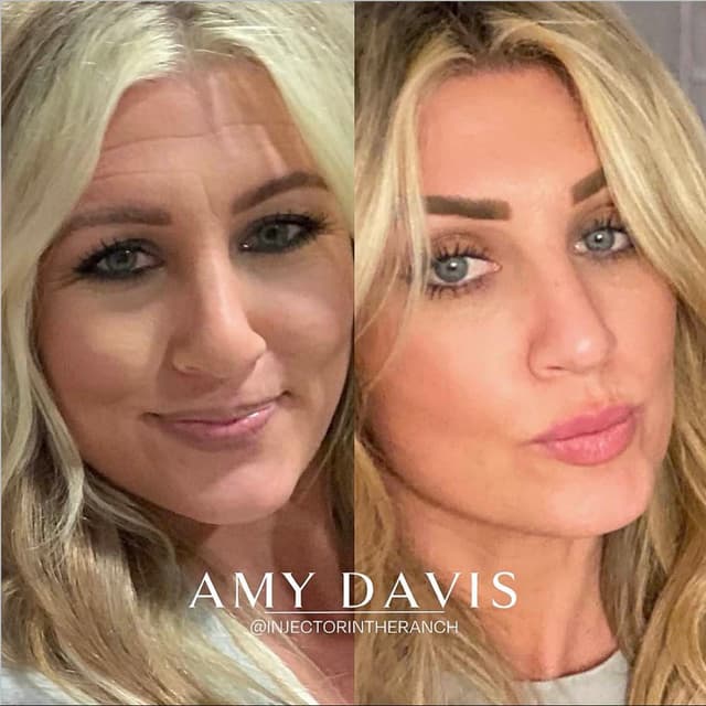 Full face filler rejuvenation results before and after