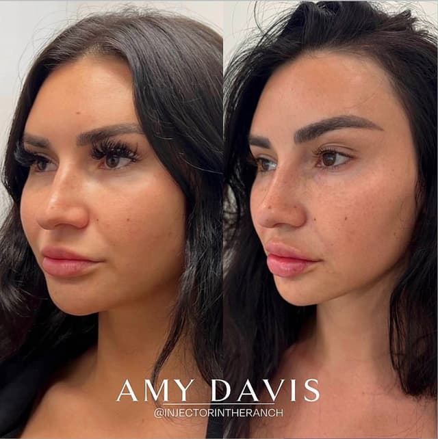 side profile jawline and chin filler before and after