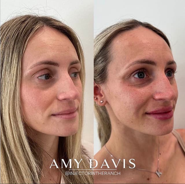 Cheek and lip balancing