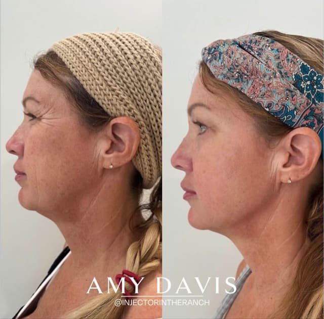 Jawline and chin filler before and after